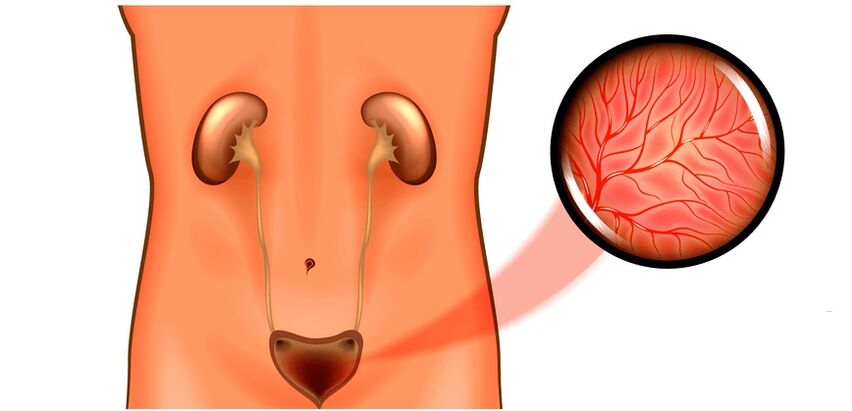 Cystitis дар симптомҳо ва табобат